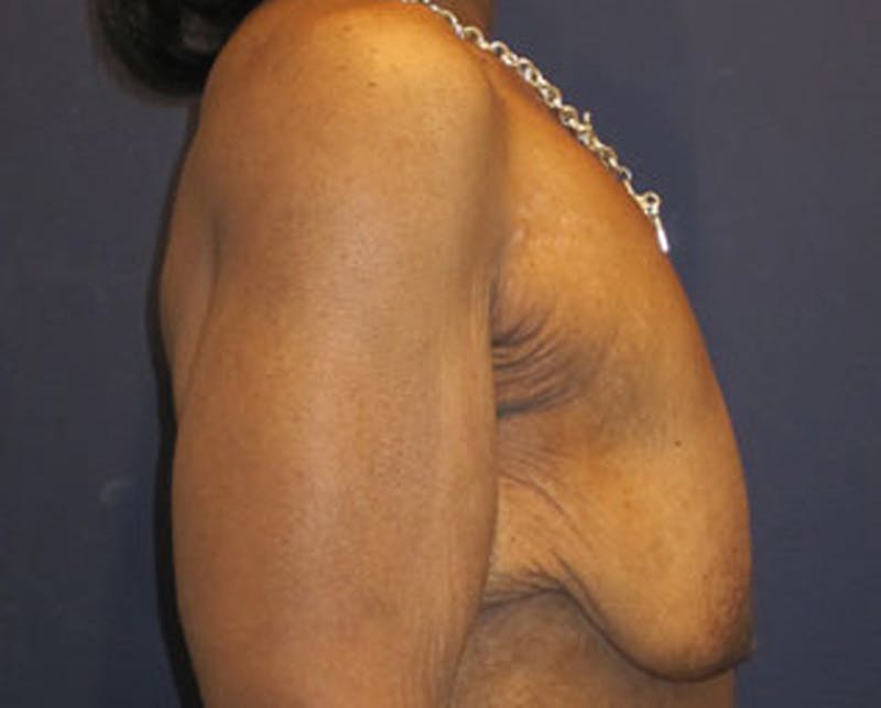 Breast Lift with Augmentation Before & After Gallery - Patient 174148882 - Image 5
