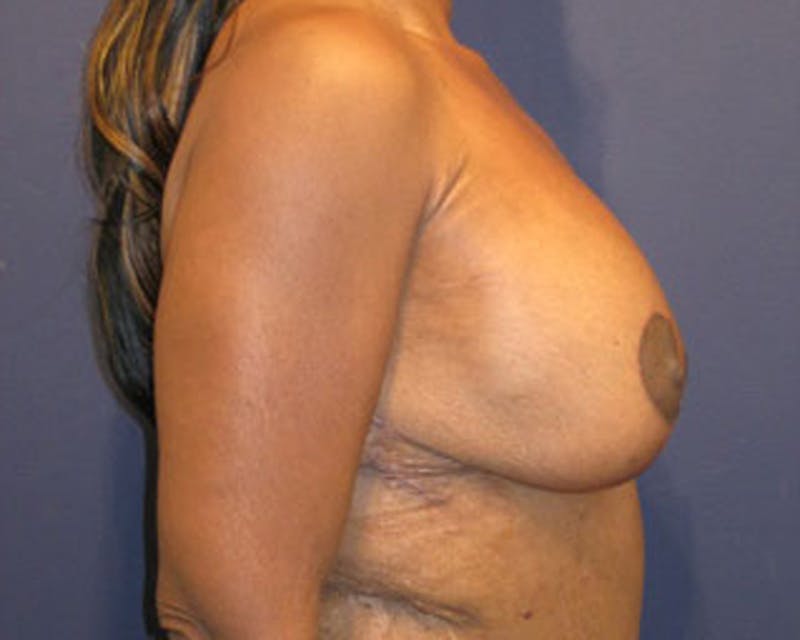 Breast Lift with Augmentation Before & After Gallery - Patient 174148882 - Image 6