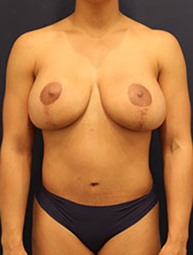 Breast Lift with Augmentation Before & After Gallery - Patient 174148889 - Image 2