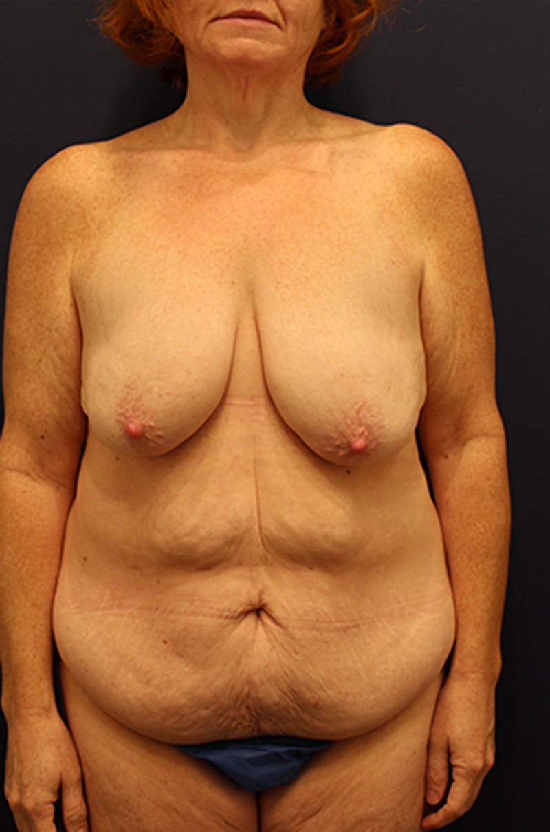 Breast Lift with Augmentation Before & After Gallery - Patient 174149976 - Image 1