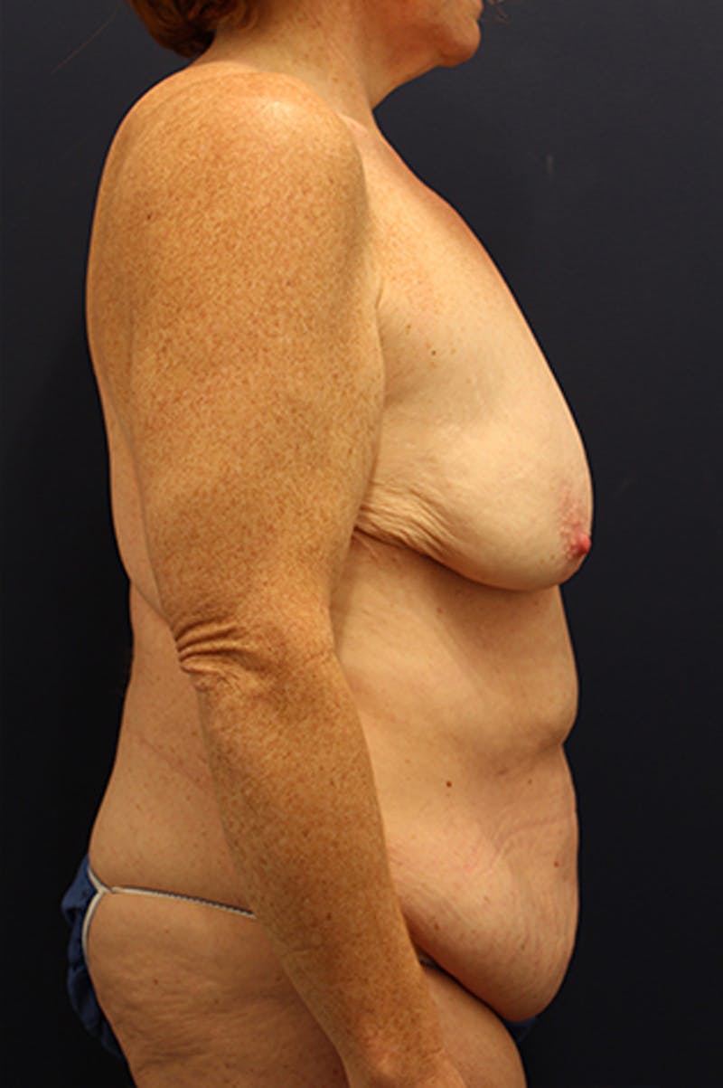 Breast Lift with Augmentation Before & After Gallery - Patient 174149976 - Image 5