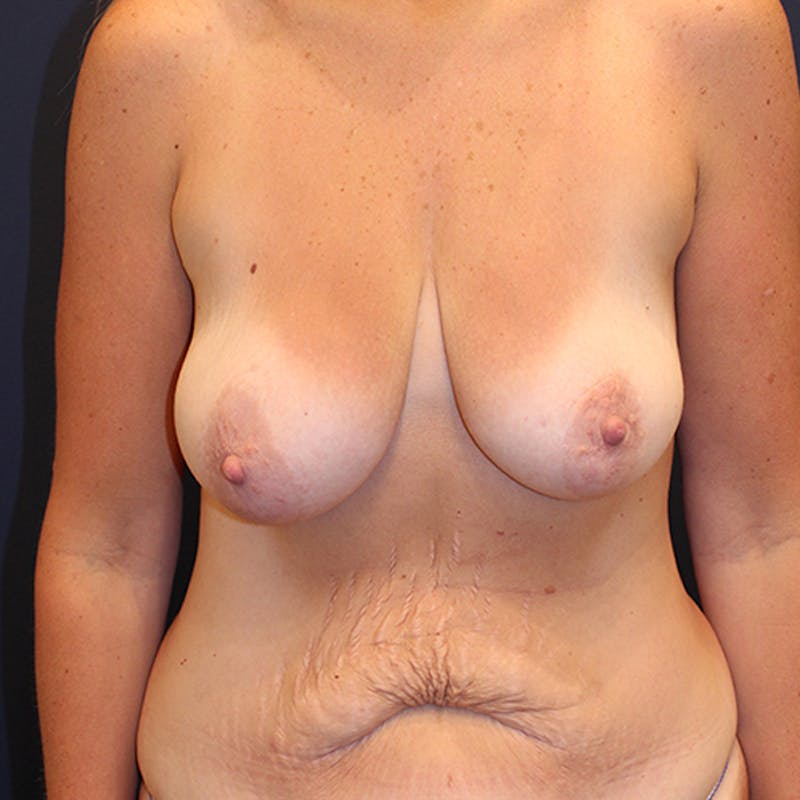 Breast Lift with Augmentation Before & After Gallery - Patient 174149982 - Image 1