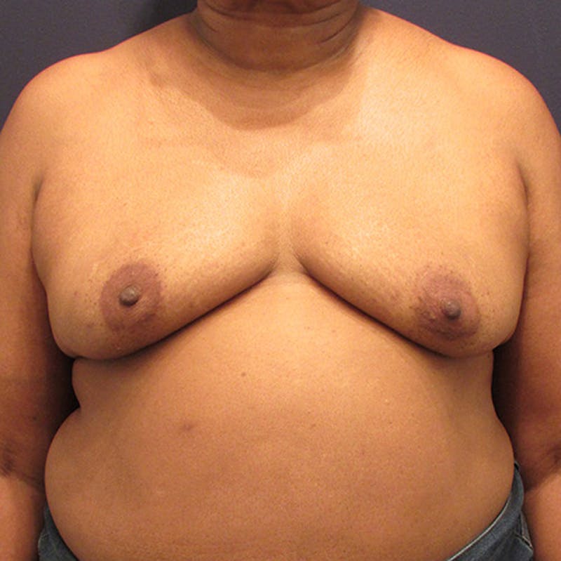 Breast Reconstruction Before & After Gallery - Patient 174147707 - Image 1