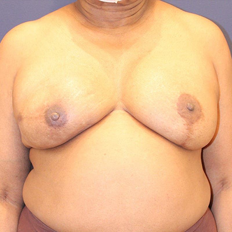 Breast Reconstruction Before & After Gallery - Patient 174147707 - Image 2