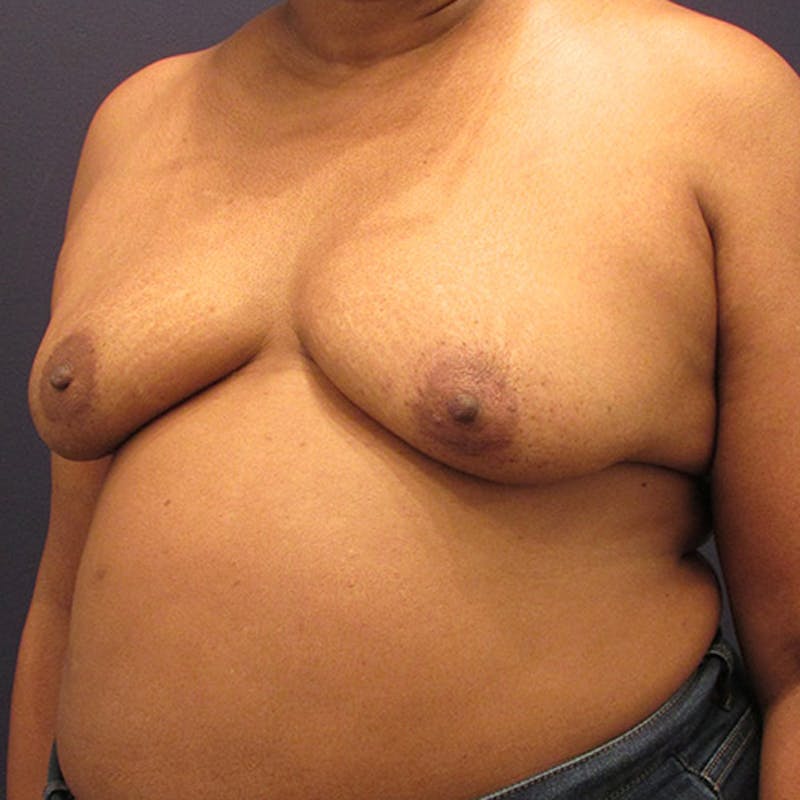 Breast Reconstruction Before & After Gallery - Patient 174147707 - Image 3
