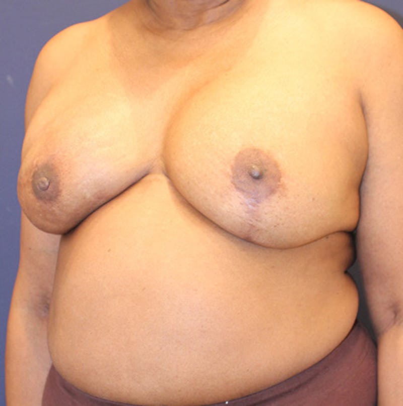 Breast Reconstruction Before & After Gallery - Patient 174147707 - Image 4