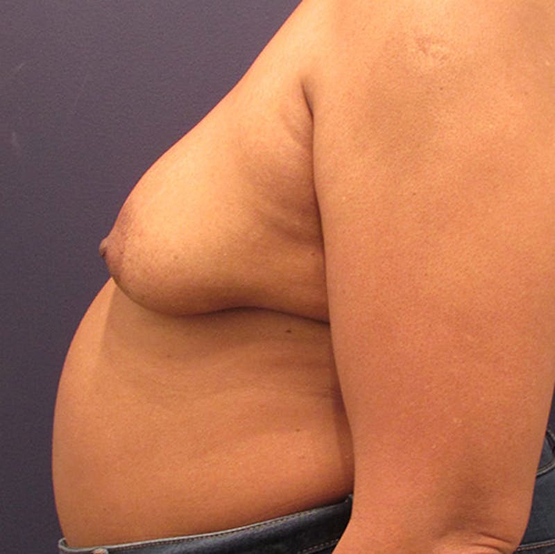 Breast Reconstruction Before & After Gallery - Patient 174147707 - Image 5