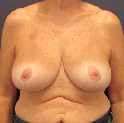 Breast Reconstruction Before & After Gallery - Patient 174147713 - Image 1