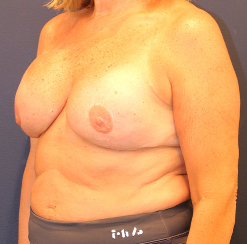Breast Reconstruction Before & After Gallery - Patient 174147713 - Image 4