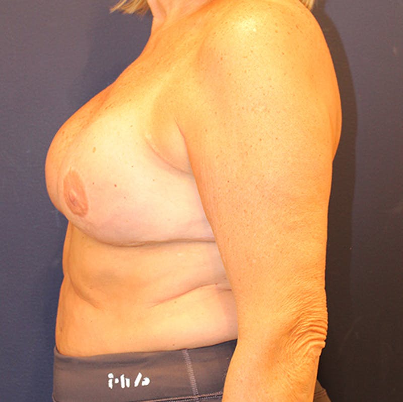 Breast Reconstruction Before & After Gallery - Patient 174147713 - Image 6