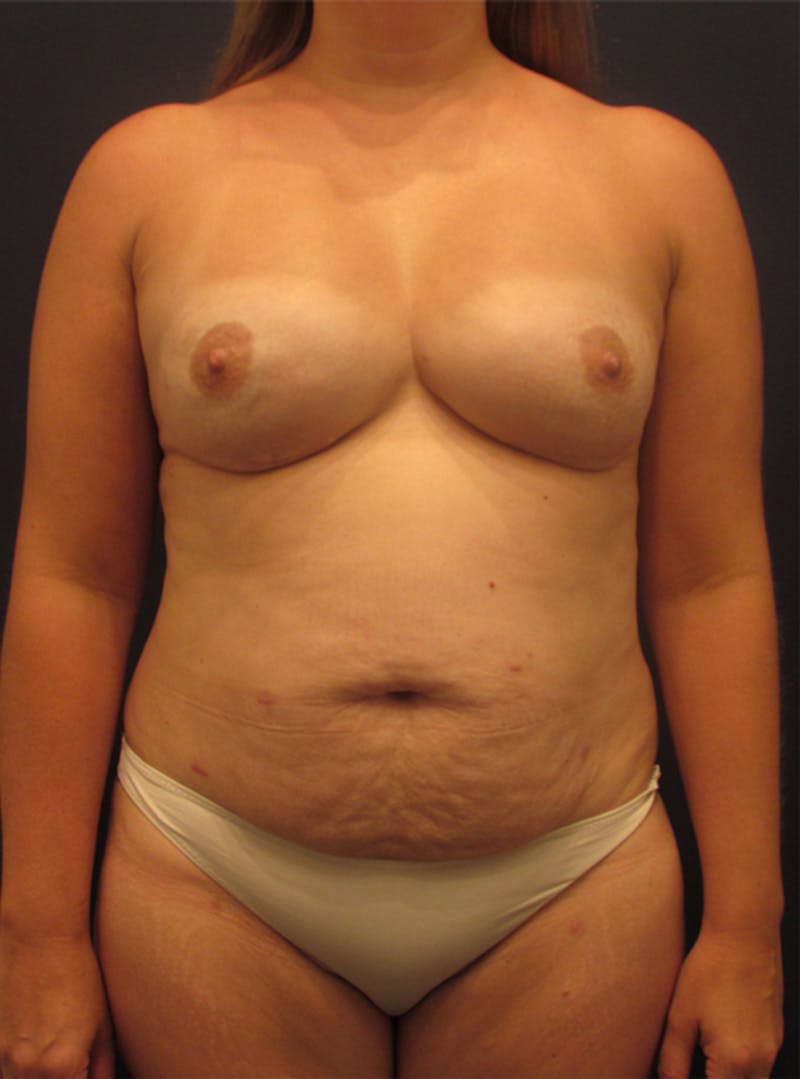 Breast Reconstruction Before & After Gallery - Patient 174148884 - Image 2