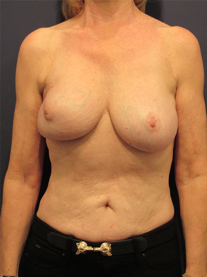 Breast Reconstruction Before & After Gallery - Patient 174149967 - Image 1