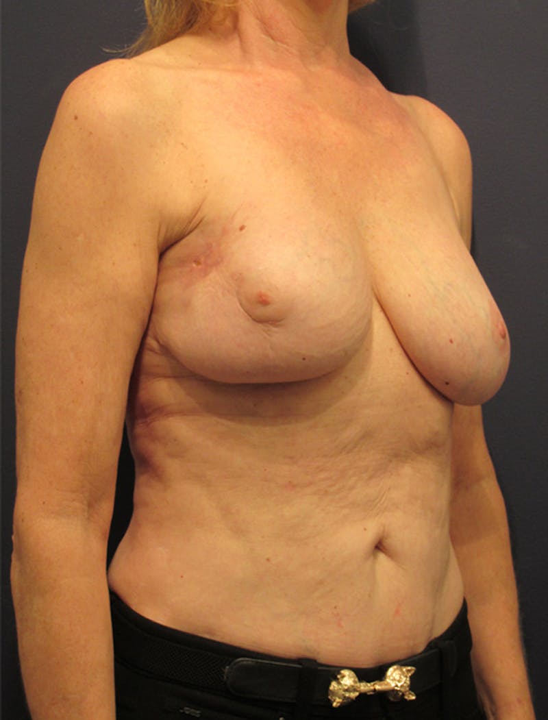 Breast Reconstruction Before & After Gallery - Patient 174149967 - Image 3