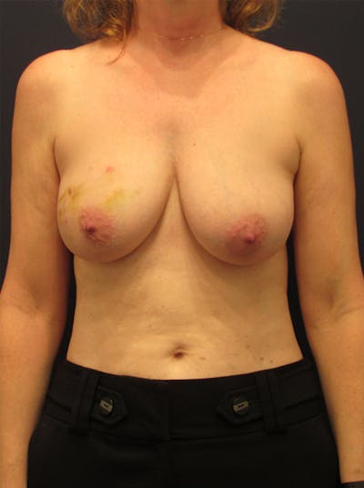 Breast Reconstruction Before & After Gallery - Patient 174149989 - Image 1