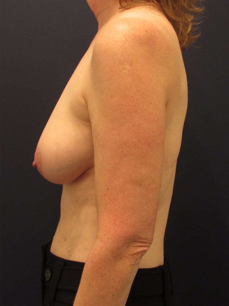 Breast Reconstruction Before & After Gallery - Patient 174149989 - Image 5