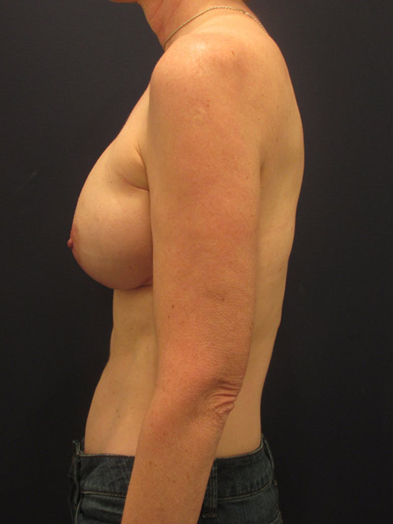 Breast Reconstruction Before & After Gallery - Patient 174149989 - Image 6