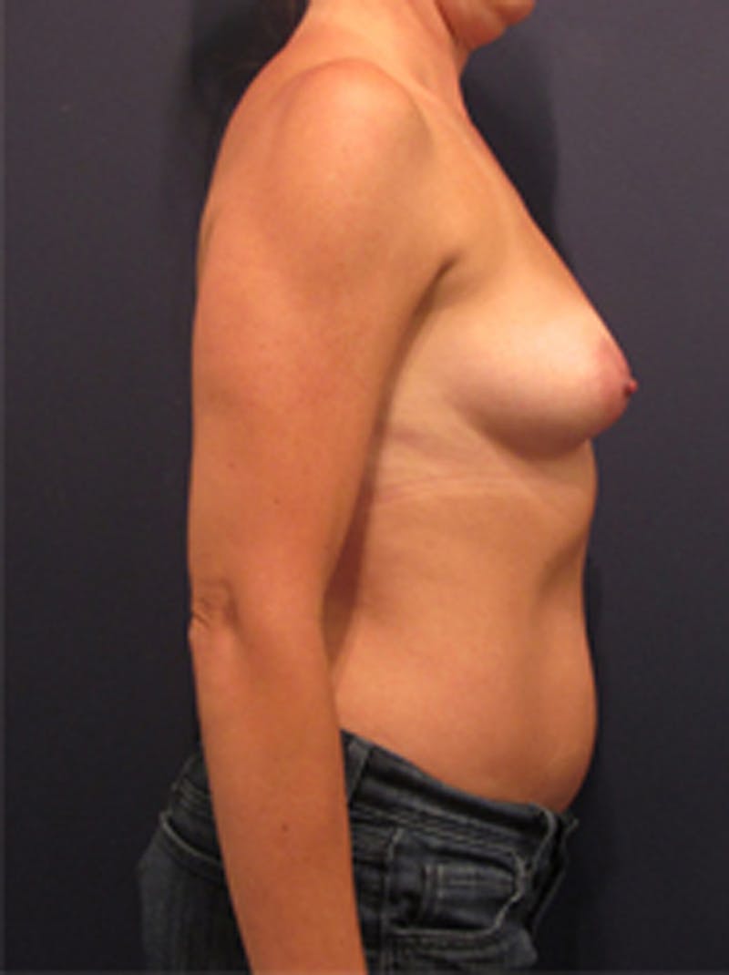 Breast Reconstruction Before & After Gallery - Patient 174149999 - Image 5