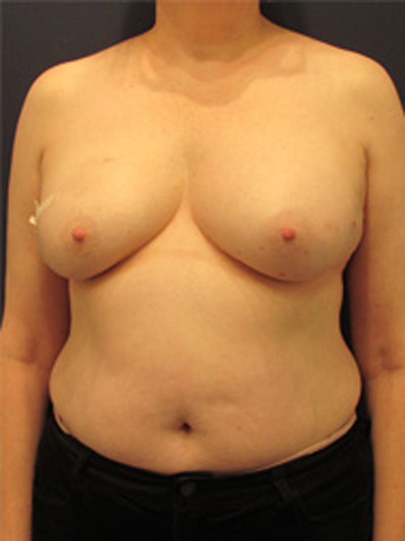 Breast Reconstruction Before & After Gallery - Patient 174150003 - Image 1