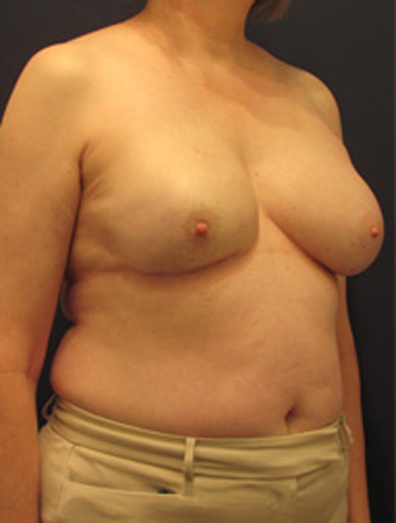 Breast Reconstruction Before & After Gallery - Patient 174150003 - Image 4