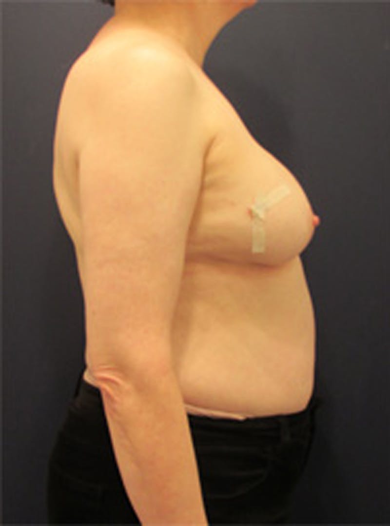 Breast Reconstruction Before & After Gallery - Patient 174150003 - Image 5