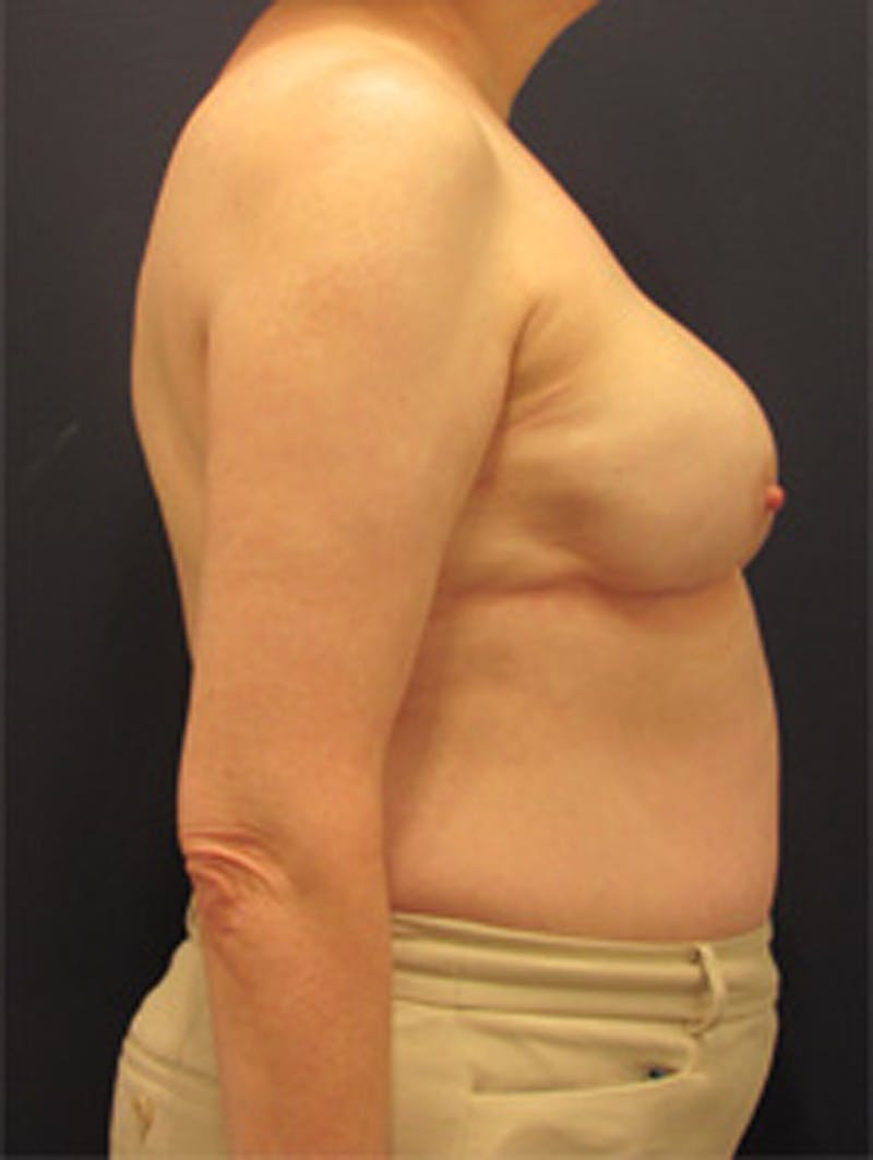 Breast Reconstruction Before & After Gallery - Patient 174150003 - Image 6