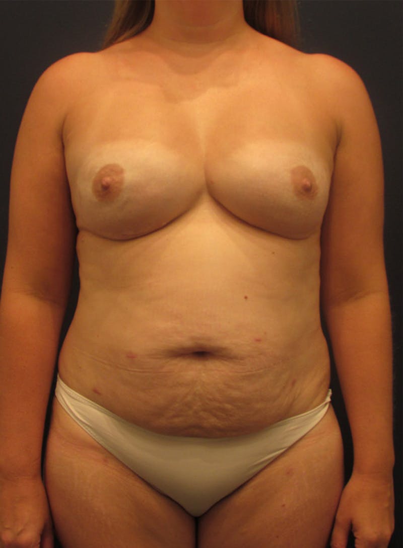 Breast Reconstruction Before & After Gallery - Patient 174150008 - Image 2