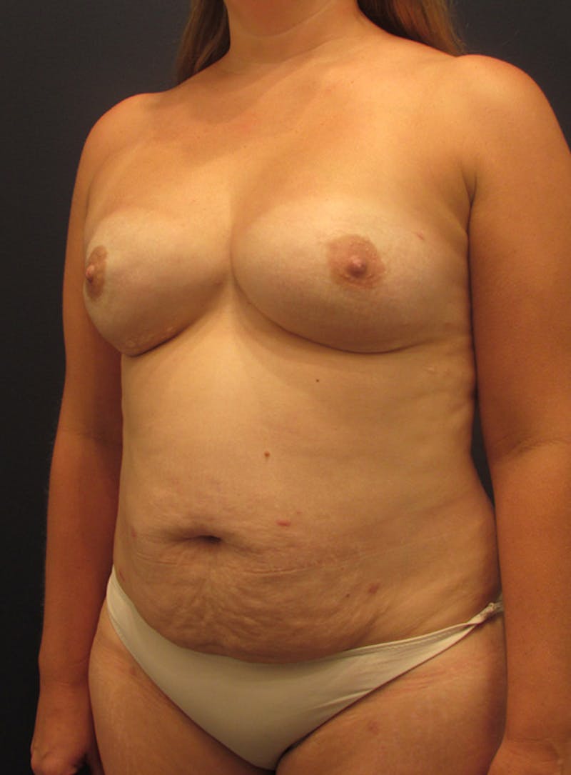Breast Reconstruction Before & After Gallery - Patient 174150008 - Image 4