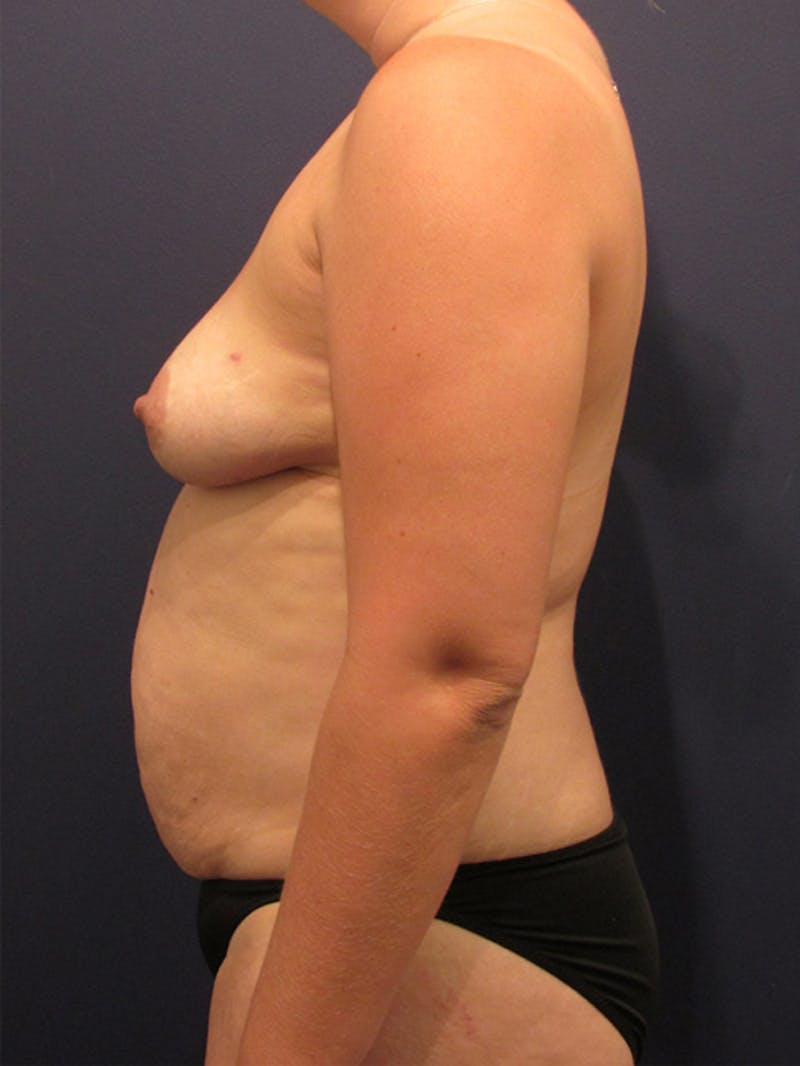 Breast Reconstruction Before & After Gallery - Patient 174150008 - Image 5