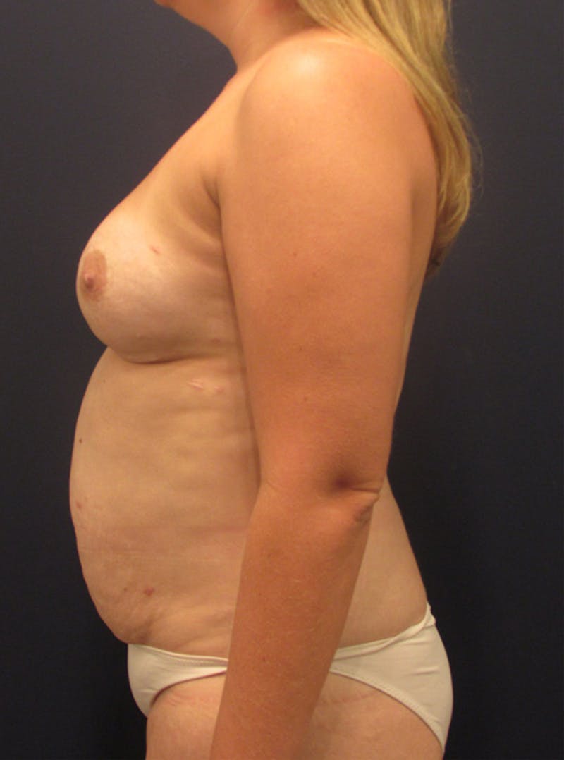 Breast Reconstruction Before & After Gallery - Patient 174150008 - Image 6