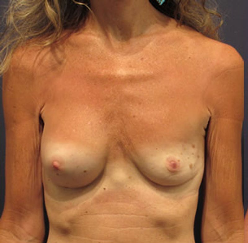 Breast Reconstruction Before & After Gallery - Patient 174150012 - Image 1