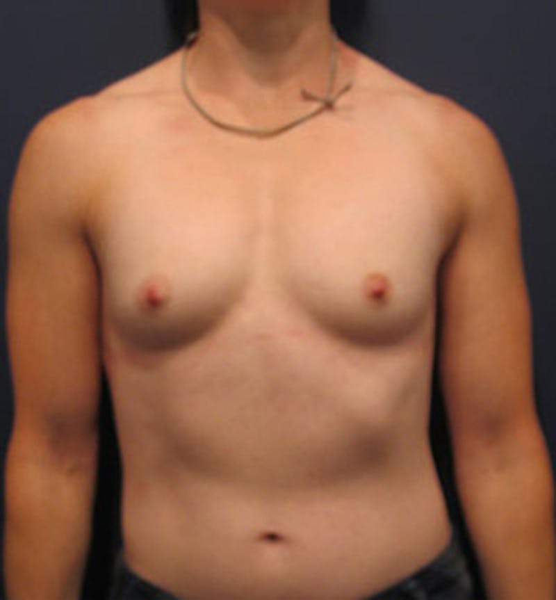 Breast Reconstruction Before & After Gallery - Patient 174150016 - Image 1