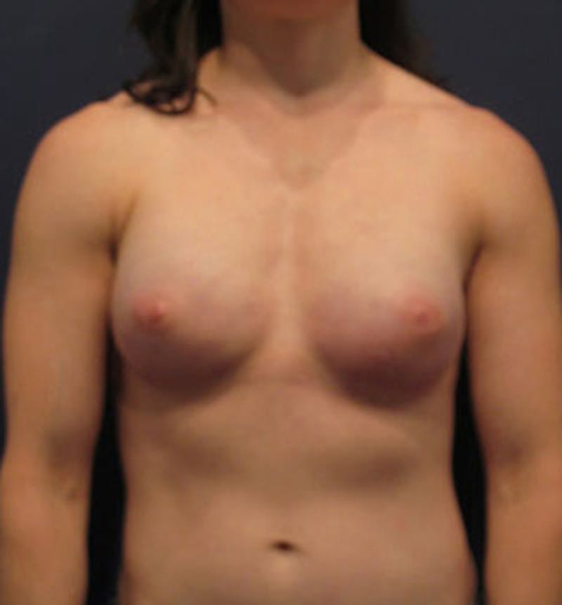 Breast Reconstruction Before & After Gallery - Patient 174150016 - Image 2