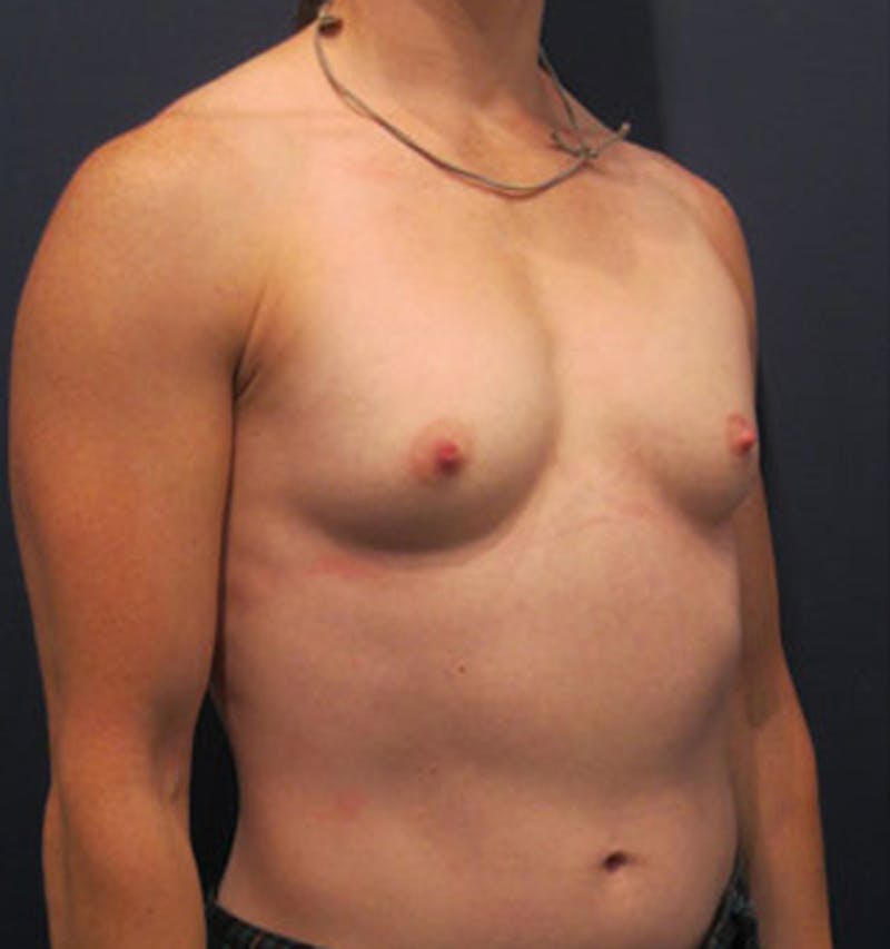Breast Reconstruction Before & After Gallery - Patient 174150016 - Image 3