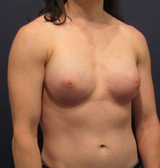 Breast Reconstruction Before & After Gallery - Patient 174150016 - Image 4