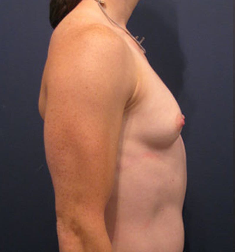 Breast Reconstruction Before & After Gallery - Patient 174150016 - Image 5