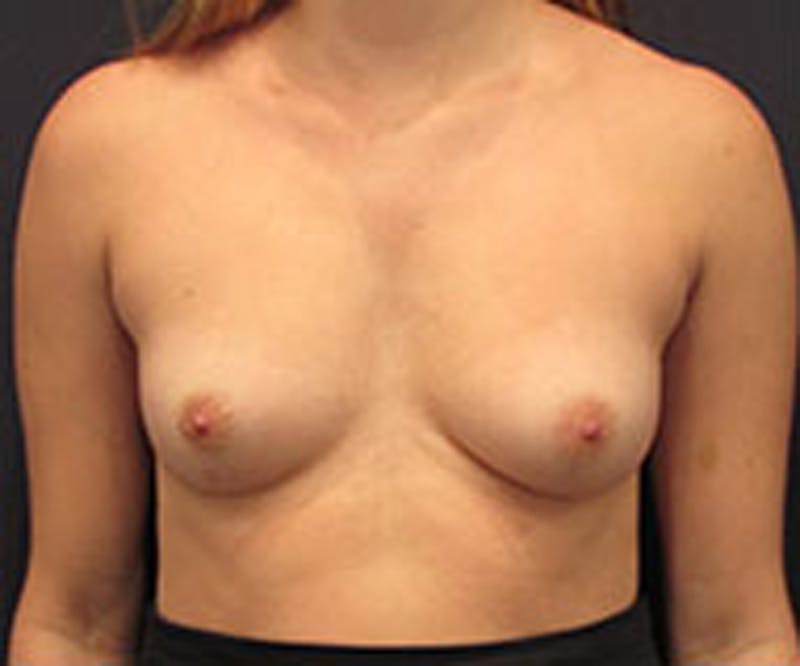 Breast Reconstruction Before & After Gallery - Patient 174150021 - Image 1