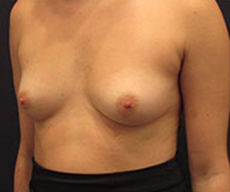 Breast Reconstruction Before & After Gallery - Patient 174150021 - Image 3