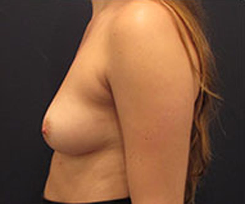 Breast Reconstruction Before & After Gallery - Patient 174150021 - Image 5