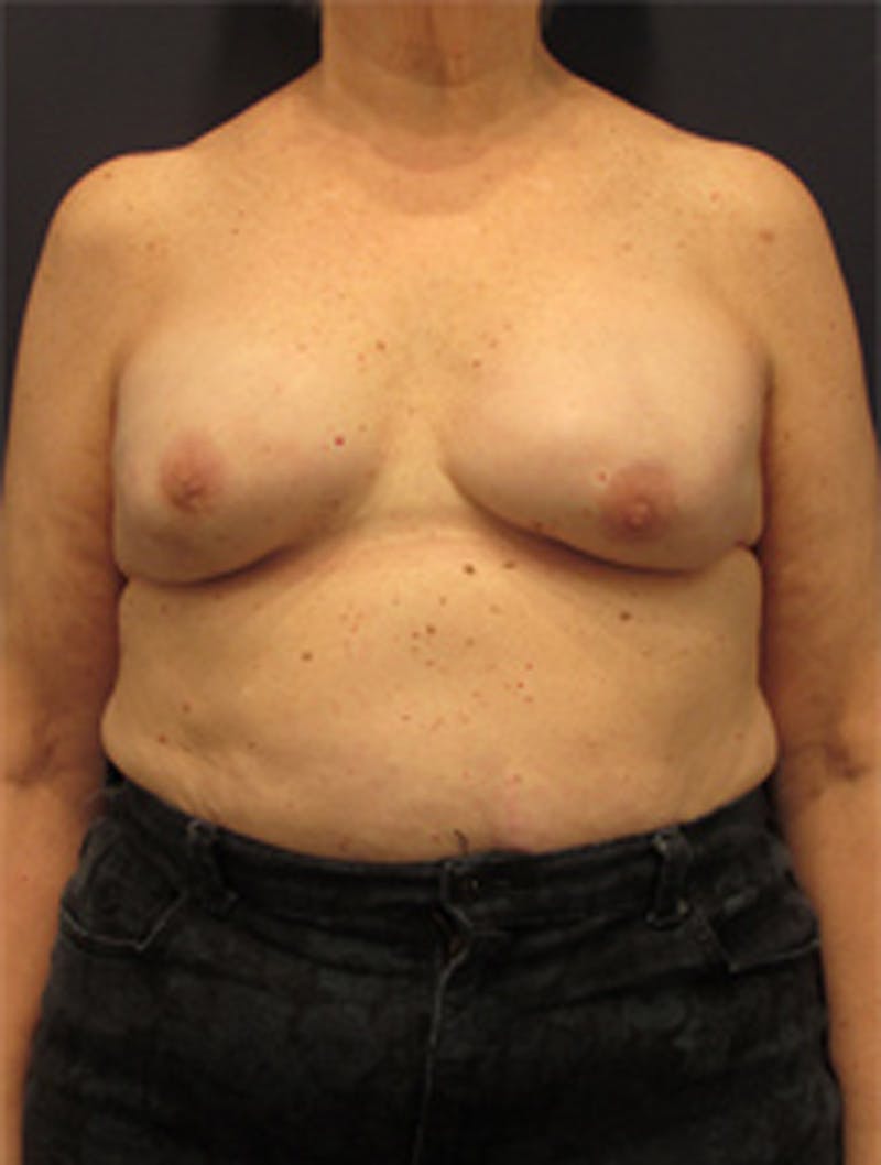 Breast Reconstruction Before & After Gallery - Patient 174150026 - Image 2
