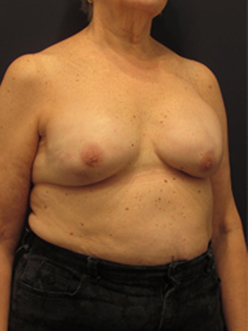 Breast Reconstruction Before & After Gallery - Patient 174150026 - Image 4