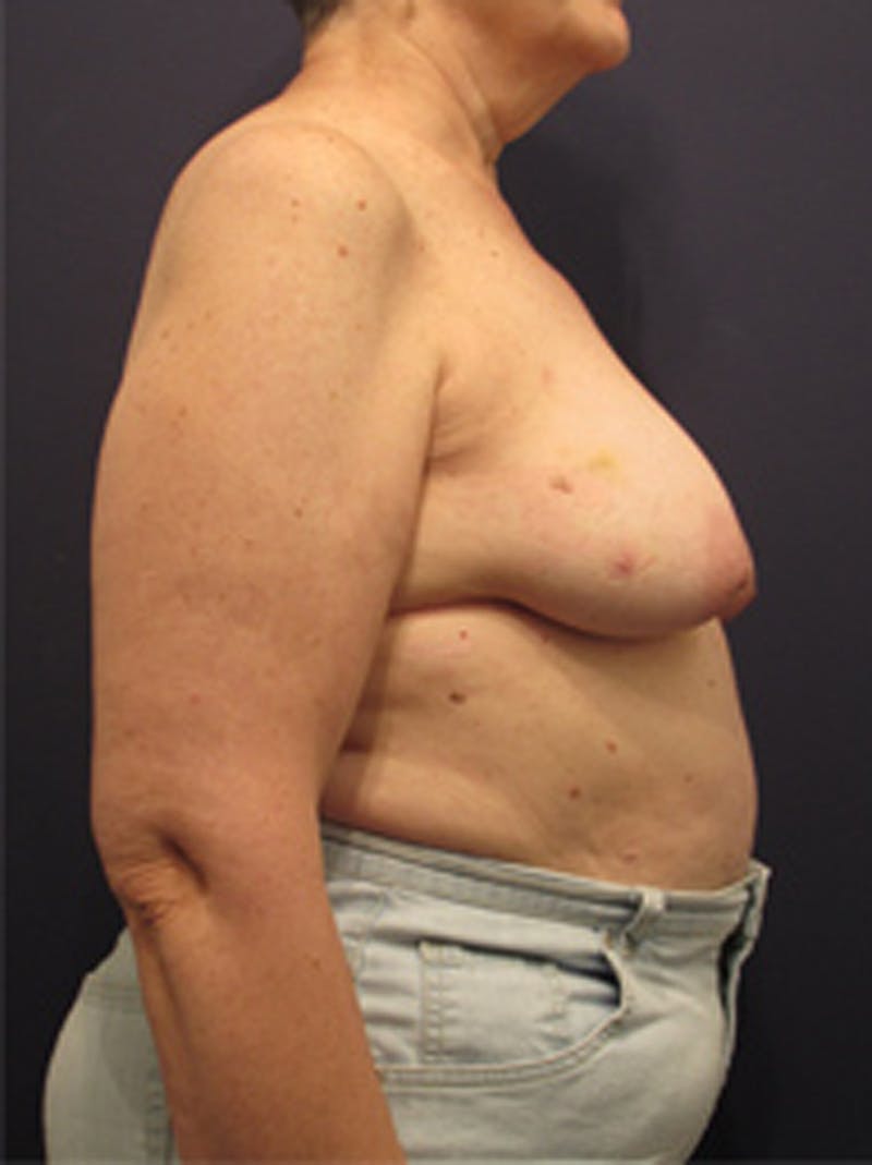 Breast Reconstruction Before & After Gallery - Patient 174150026 - Image 5