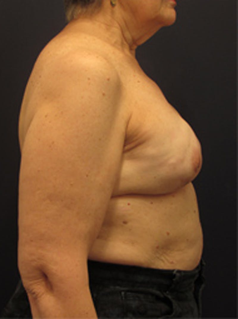 Breast Reconstruction Before & After Gallery - Patient 174150026 - Image 6