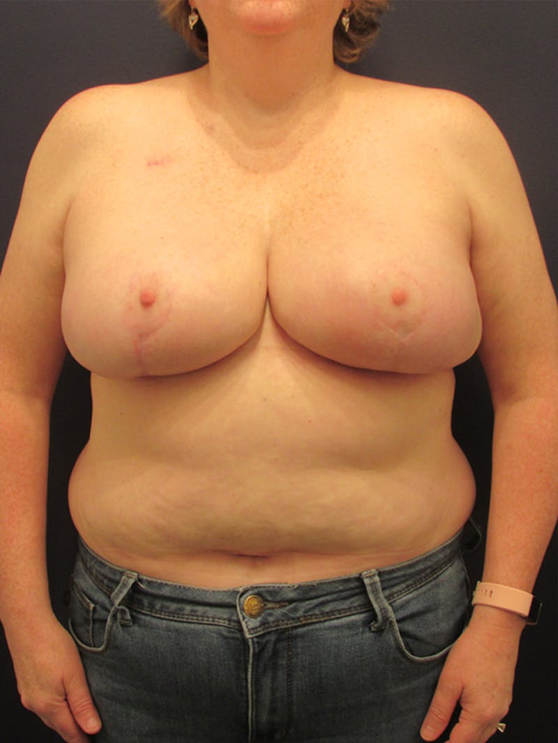 Breast Reconstruction Before & After Gallery - Patient 174150031 - Image 2