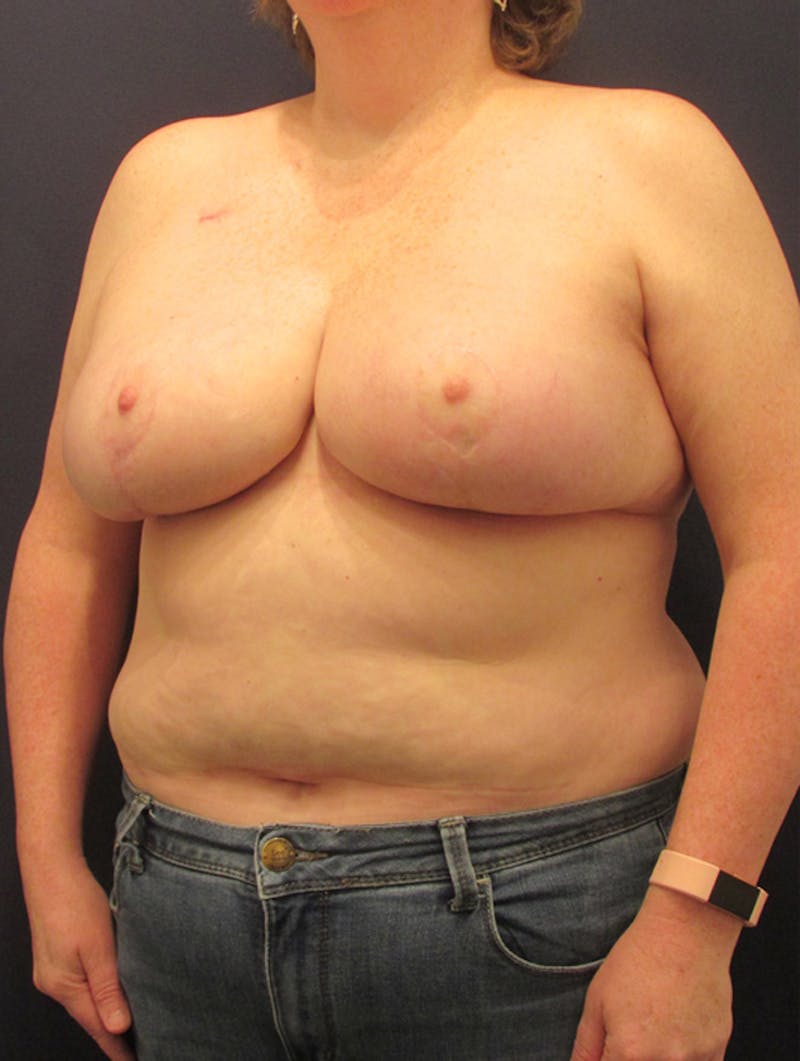 Breast Reconstruction Before & After Gallery - Patient 174150031 - Image 4
