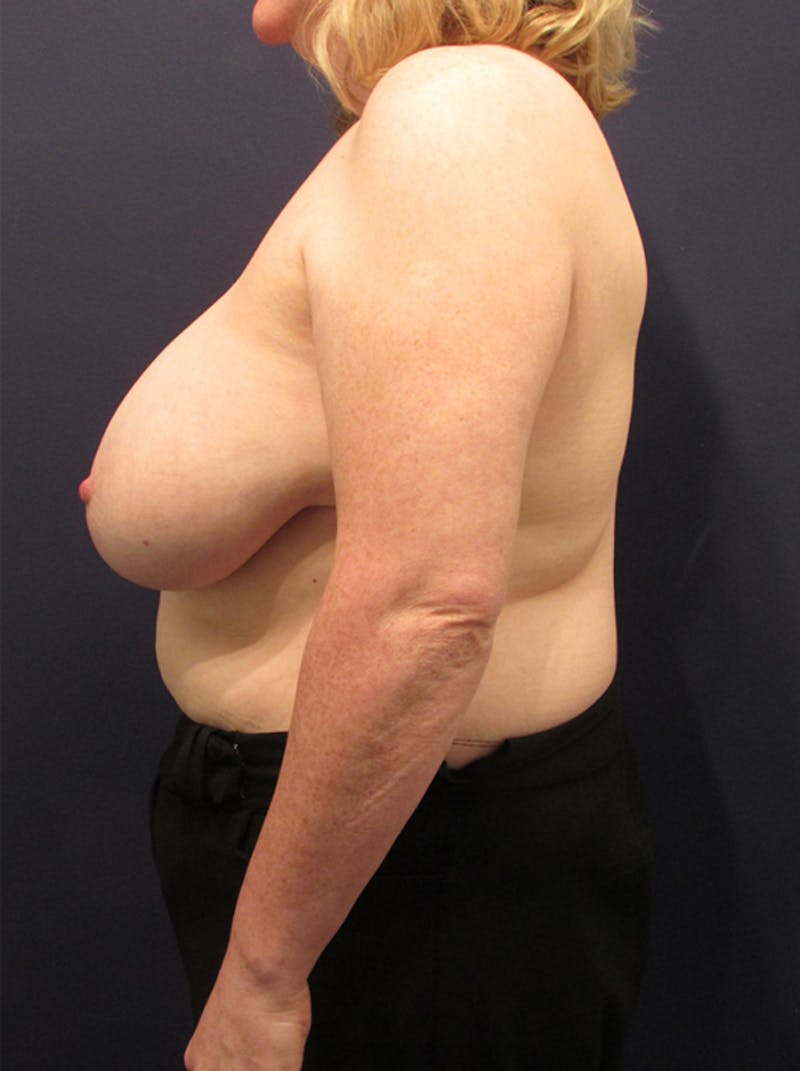 Breast Reconstruction Before & After Gallery - Patient 174150031 - Image 5