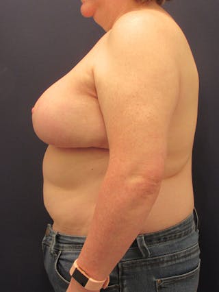 Breast Reconstruction Before & After Gallery - Patient 174150031 - Image 6