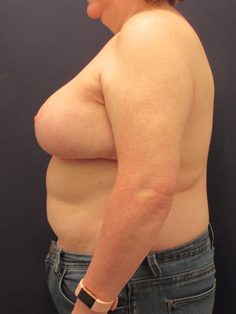 Breast Reconstruction Before & After Gallery - Patient 174150031 - Image 6