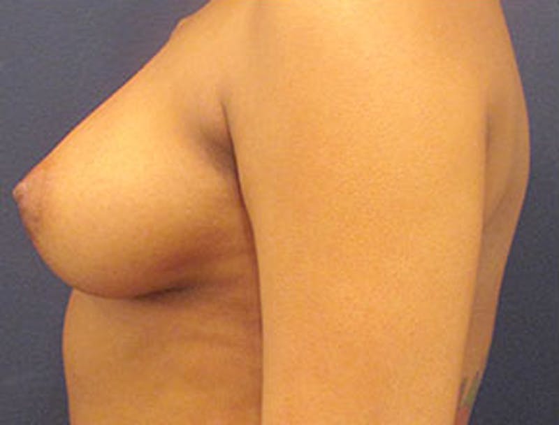 Breast Reconstruction Before & After Gallery - Patient 174160938 - Image 5