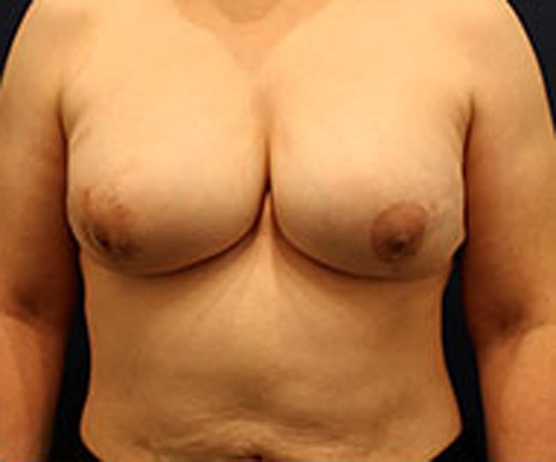 Breast Reconstruction Before & After Gallery - Patient 174160945 - Image 2
