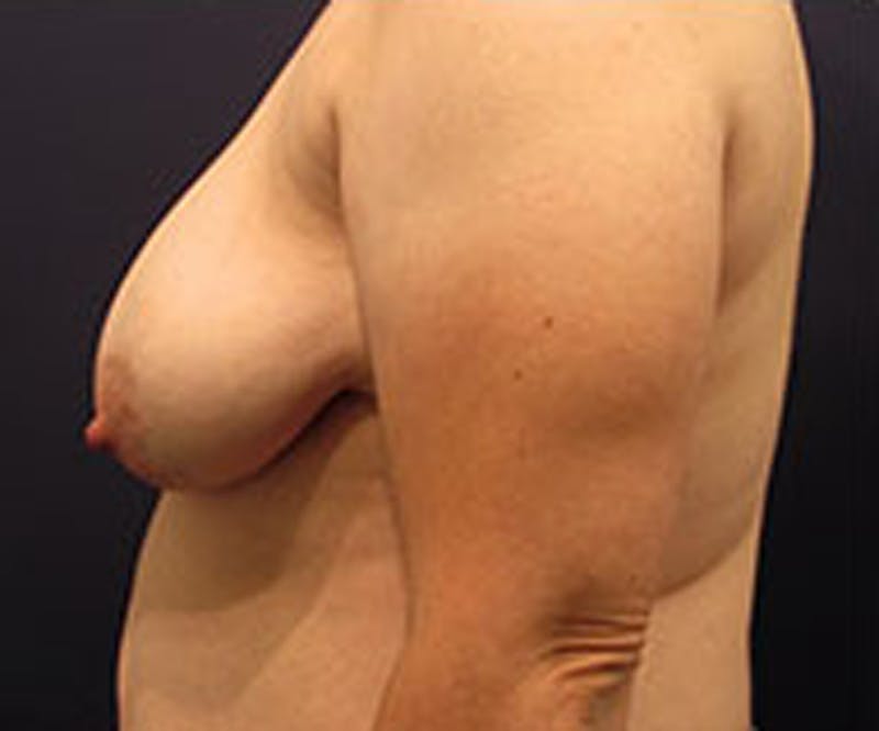 Breast Reconstruction Before & After Gallery - Patient 174160945 - Image 5